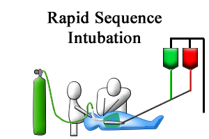 Rapid Sequence Intubation